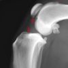 Most dogs with rupture of the cruciate ligament will have some degree of new bone formation in the areas highlighted by the arrows. This bone formation is associated with osteoarthritis and is expected to become progressively worse with time.